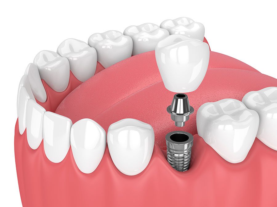 3D dental implants rendering