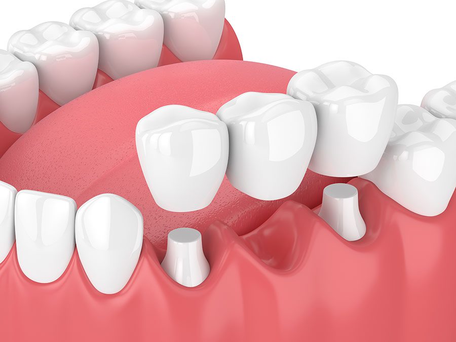 3d dental bridge rendering