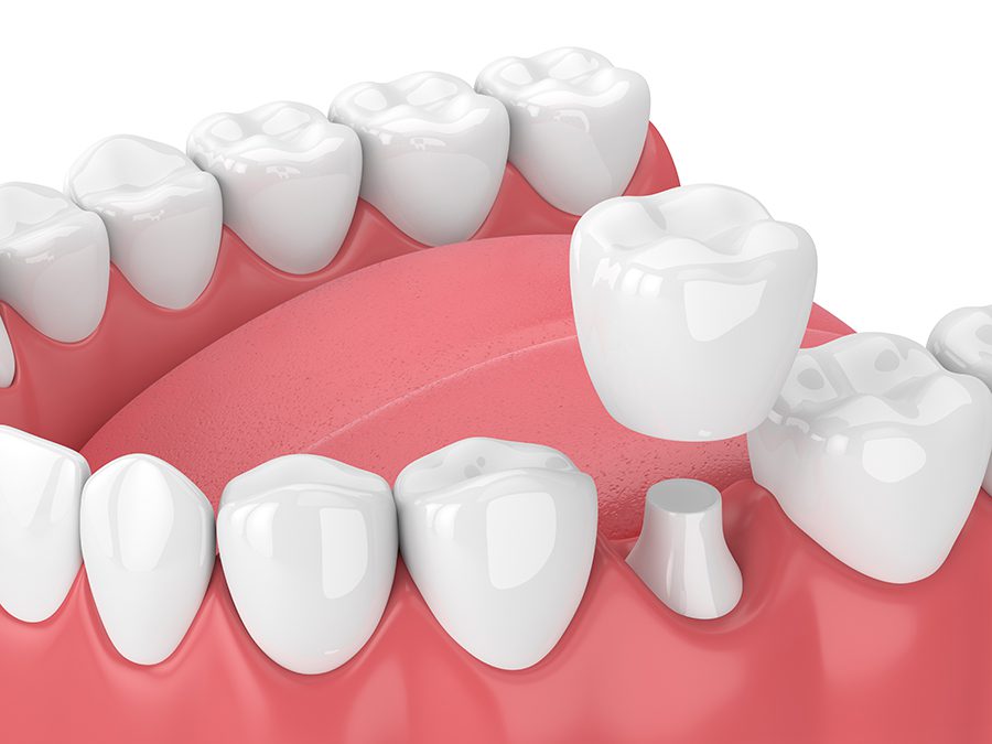 3D dental crown rendering