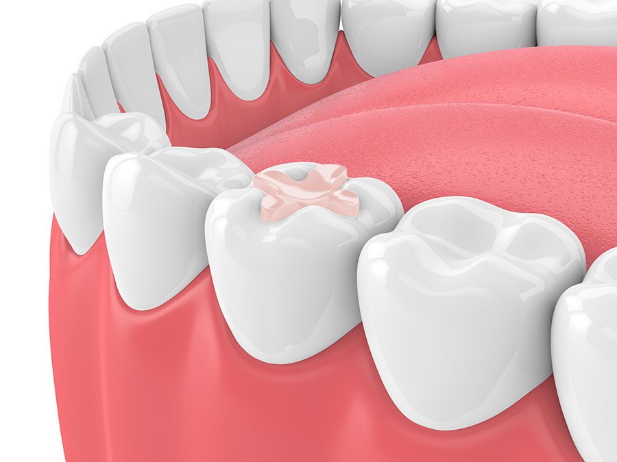 3D dental filling rendering