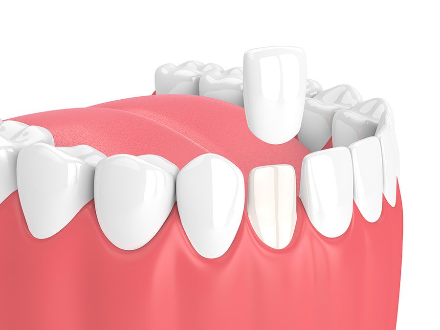 3D dental bonding rendering