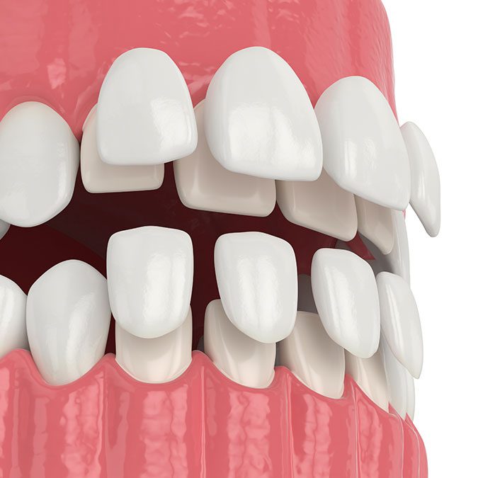 3d render of jaw with upper and lower veneers over white