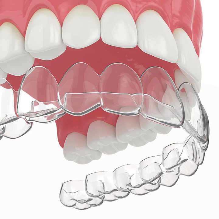 3d render of jaw with upper invisalign removable retainer